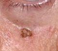 Image of Actinic Keratosis on the face, a specific type of wart